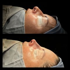 Rinoplastia - Dr. Rigoberto Castellanos