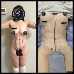 Abdominoplastia en flor de lis con aumento de busto - Dr. Rigoberto Castellanos