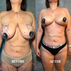 Mastopexia - Dr. Rigoberto Castellanos