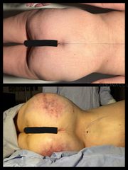 Lipoescultura + BBL - Dr. Rigoberto Castellanos