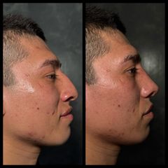 Rinoplastia -Dr. Rigoberto Castellanos