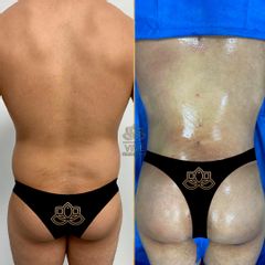 Brazilian Butt Lift - VivePlastic