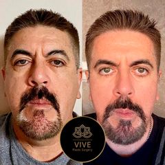 Facelift - Levantamiento facial - VivePlastic