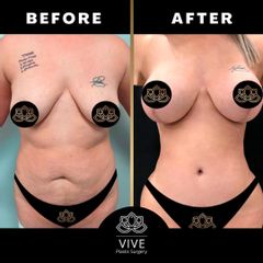 Lipo +Implantes mamarios + pexia - VivePlastic