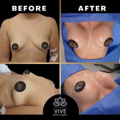 Implantes mamarios - VivePlastic