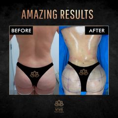 BBL y Liposuction, before and after Enero 2023 Vive plastic surgery