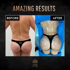 Resultado Antes y Después de Lipoescultura con Brazilian Butt Lift