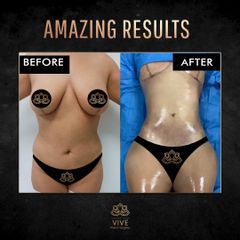 Mommy Makeover Before and After Enero-2023