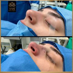 Rinoplastia Before and After Enero 2023