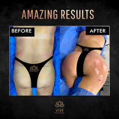 Lipo y BBL, Before y After Enero 2023