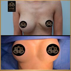 Implantes de pechos, Before and After Enero 2023