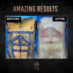 Six Pack Lipoescultura before and after 2023 Vive plastic surgery