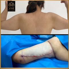 Braquioplastia before y after 2023 Vive plastic surgery