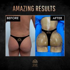 BBL y Liposuction, before and after Enero 2023 Vive plastic surgery
