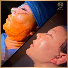 Liposucción de Papada y Ritidectomía before y after Enero 2023 Vive Plastic Surgery