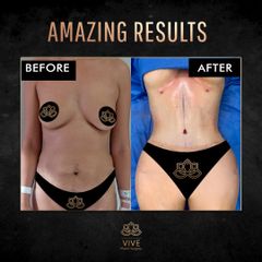 Tummy Tuck, Adbominoplastia before y after Enero 2023 Vive plastic Surgery