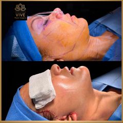 Ritidectomía before y after Enero 2023 Vive Plastic Surgery
