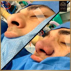 Rinoplastia Before and After Enero 2023 Vive plastic surgery