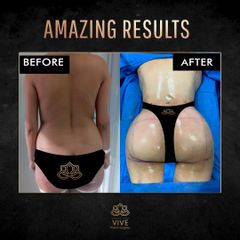 BBL y Liposuction, before and after Enero 2023 Vive plastic surgery