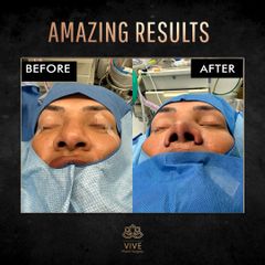 Rinoplastia Before and After Enero 2023 Vive plastic surgery