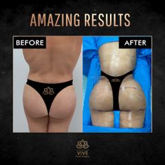 BBL y Liposuction, before and after Enero 2023 Vive plastic surgery