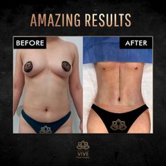 Abdominoplastia - Vive Plastic