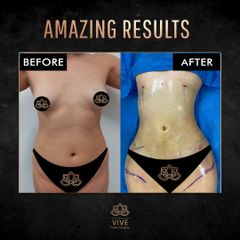 J-plasma, Liposucción, Lipoescultura - Vive Plastic