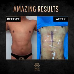 Six Pack Lipoescultura- Vive plastic surgery