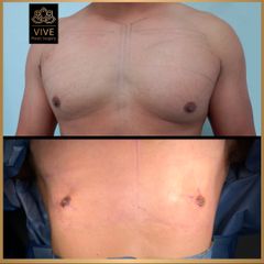 Mastectomía.- Vive Plastic Surgery