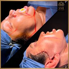 Facelift , cirugia facial - Vive Plastic Surgery