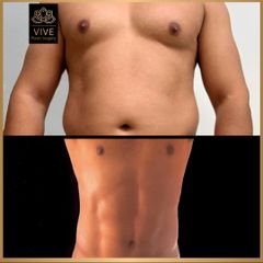 Six Pack Lipoescultura- Vive plastic surgery