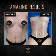 Liposucción - Vive Plastic Surgery