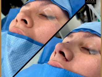 Rinoplastia - 847729