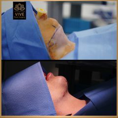 Liposucción de Papada- Vive Plastic Surgery
