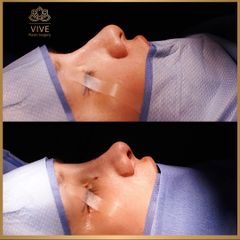 Rinoplastia - Vive Plastic Surgery