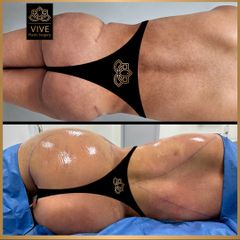 BBL- Vive Plastic Surgery