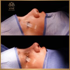 Rinoplastia - Vive Plastic Surgery