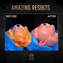 Ritidectomía - Vive Plastic Surgery