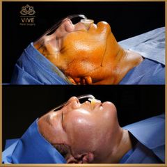 Ritidectomía - Vive Plastic Surgery