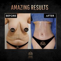 Tummy Tuck, Adbominoplastia - Vive plastic Surgery