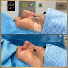 Rinoplastia- Vive Plastic Surgery