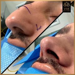 Rinoplastia- Vive Plastic Surgery