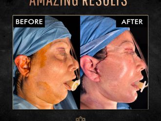 Cirugía facial - 852927