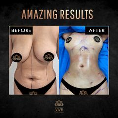 Lipoescultura - Vive Plastic Surgery