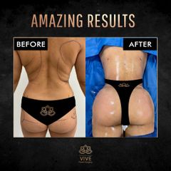 BBL- Vive Plastic Surgery