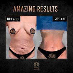 Tummy Tuck, Adbominoplastia - Vive plastic Surgery