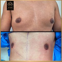 Ginecomastia - Vive Plastic Surgery
