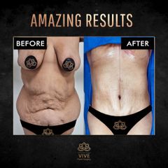 Tummy Tuck, Adbominoplastia - Vive plastic Surgery