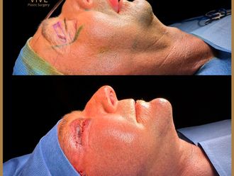 Cirugía facial - 856164