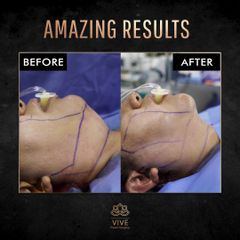 Liposucción de Papada - Vive Plastic Surgery
